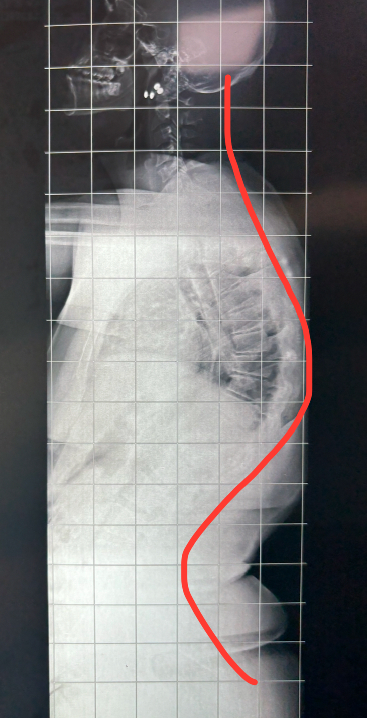 Cifose de Scheuermann: a famosa corcunda