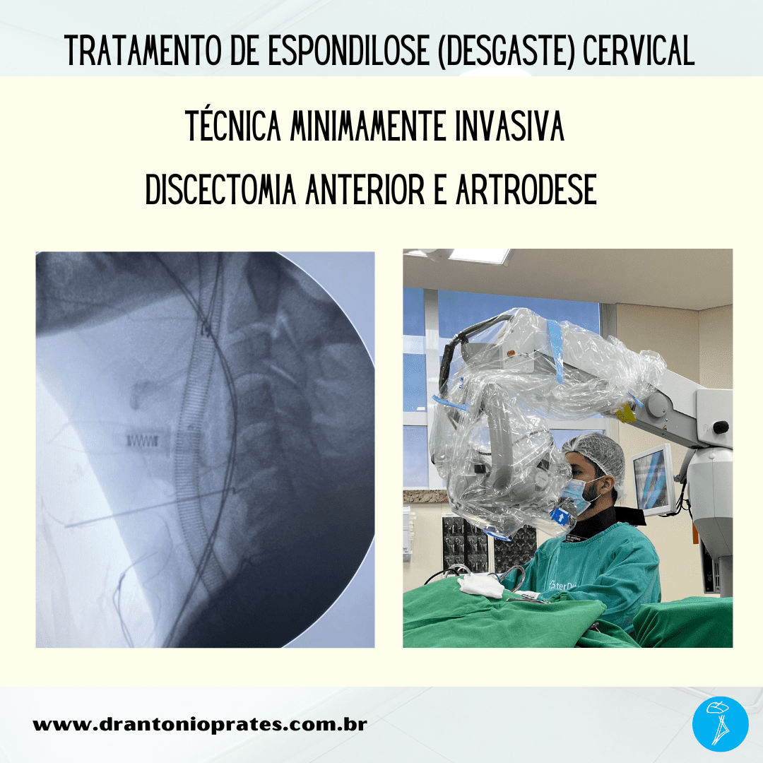 Espondilose cervical (desgaste no pescoço): caso clínico