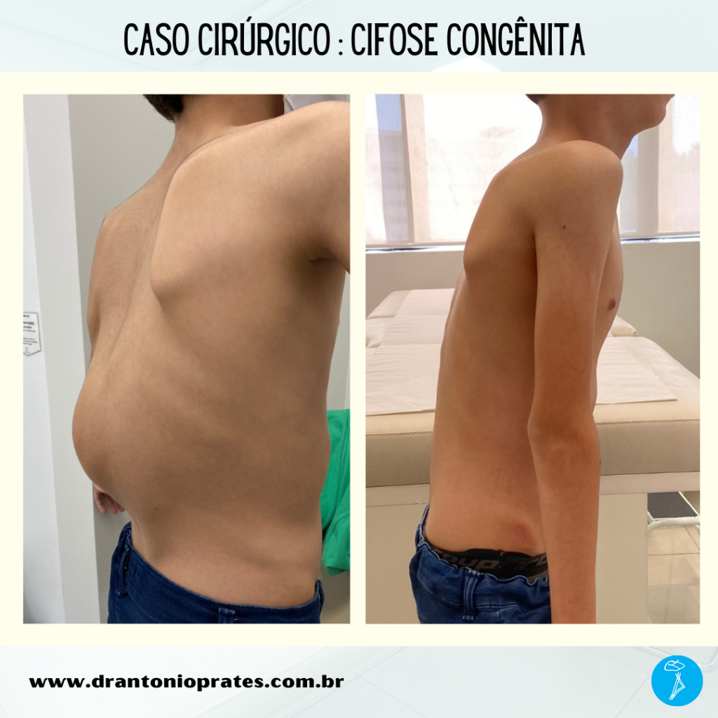 Cifose congênita - Dr Antônio Prates