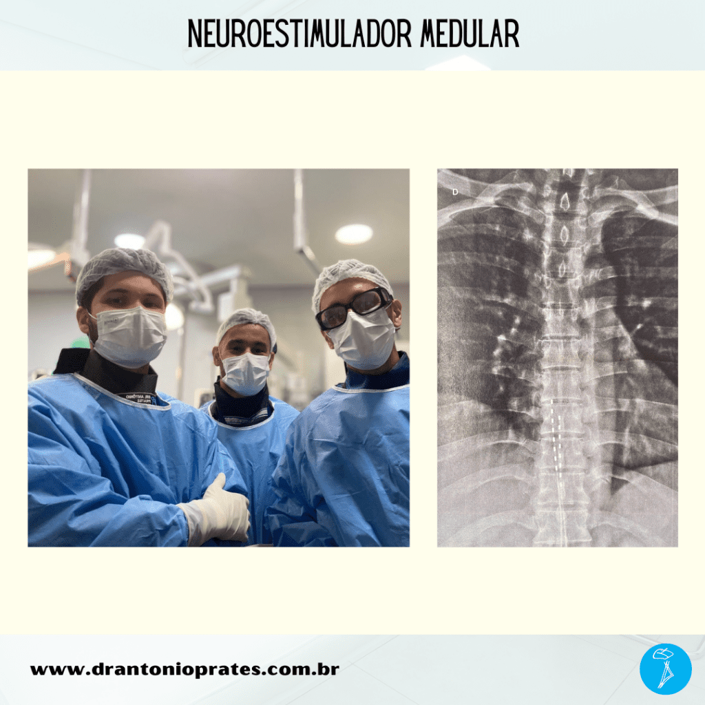 Neuroestimulador medular
