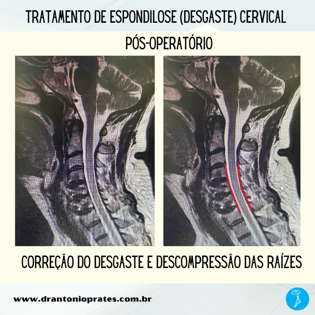 Espondilose cervical - Imagem 3