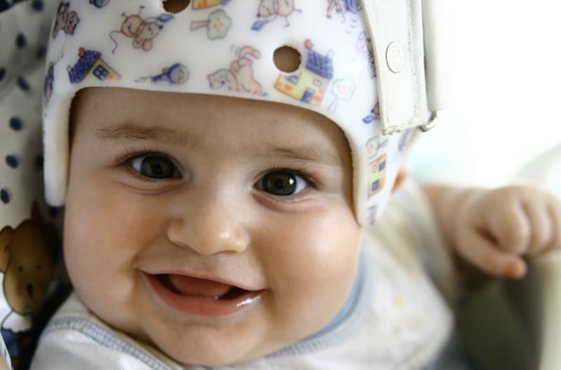 Plagiocefalia posicional