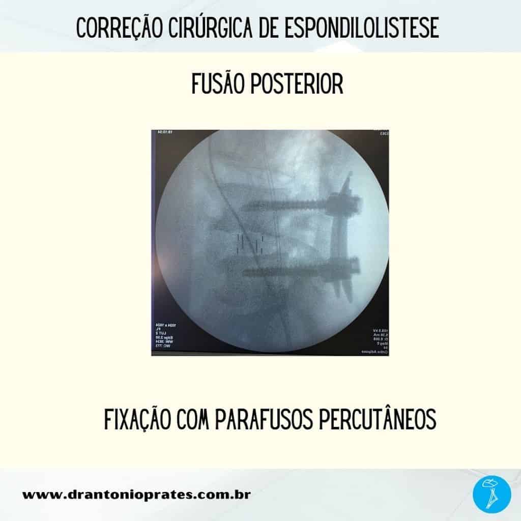 Espondilolistese - Imagem 3