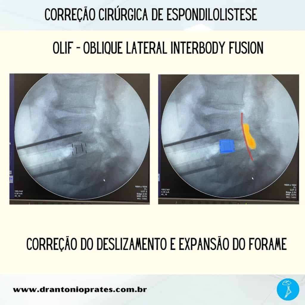 Espondilolistese - Imagem 2