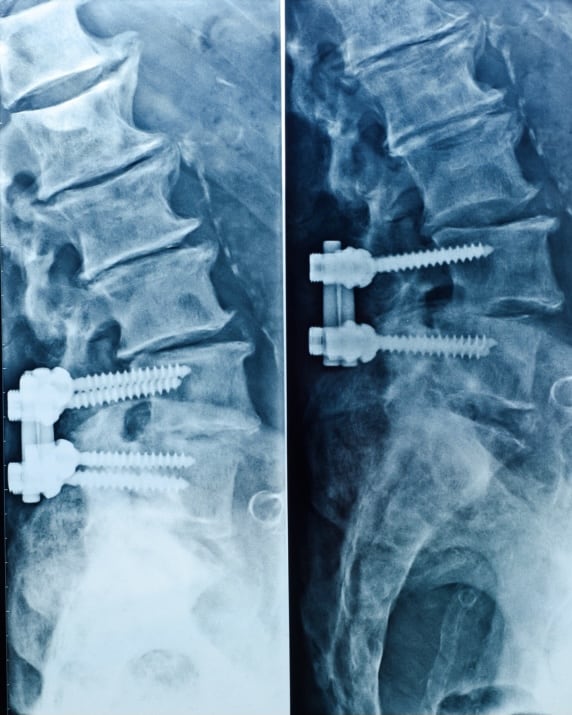 Artrodese da coluna lombar