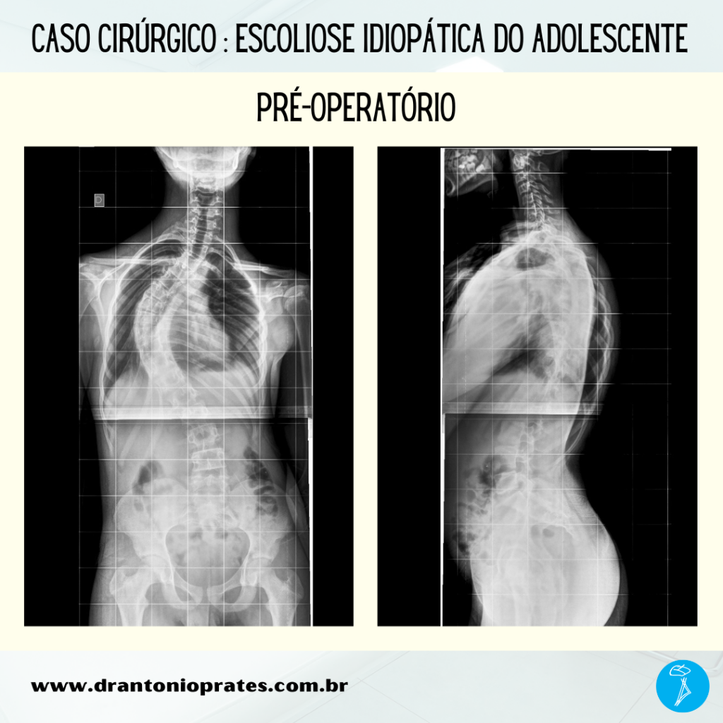 Escoliose idiopática