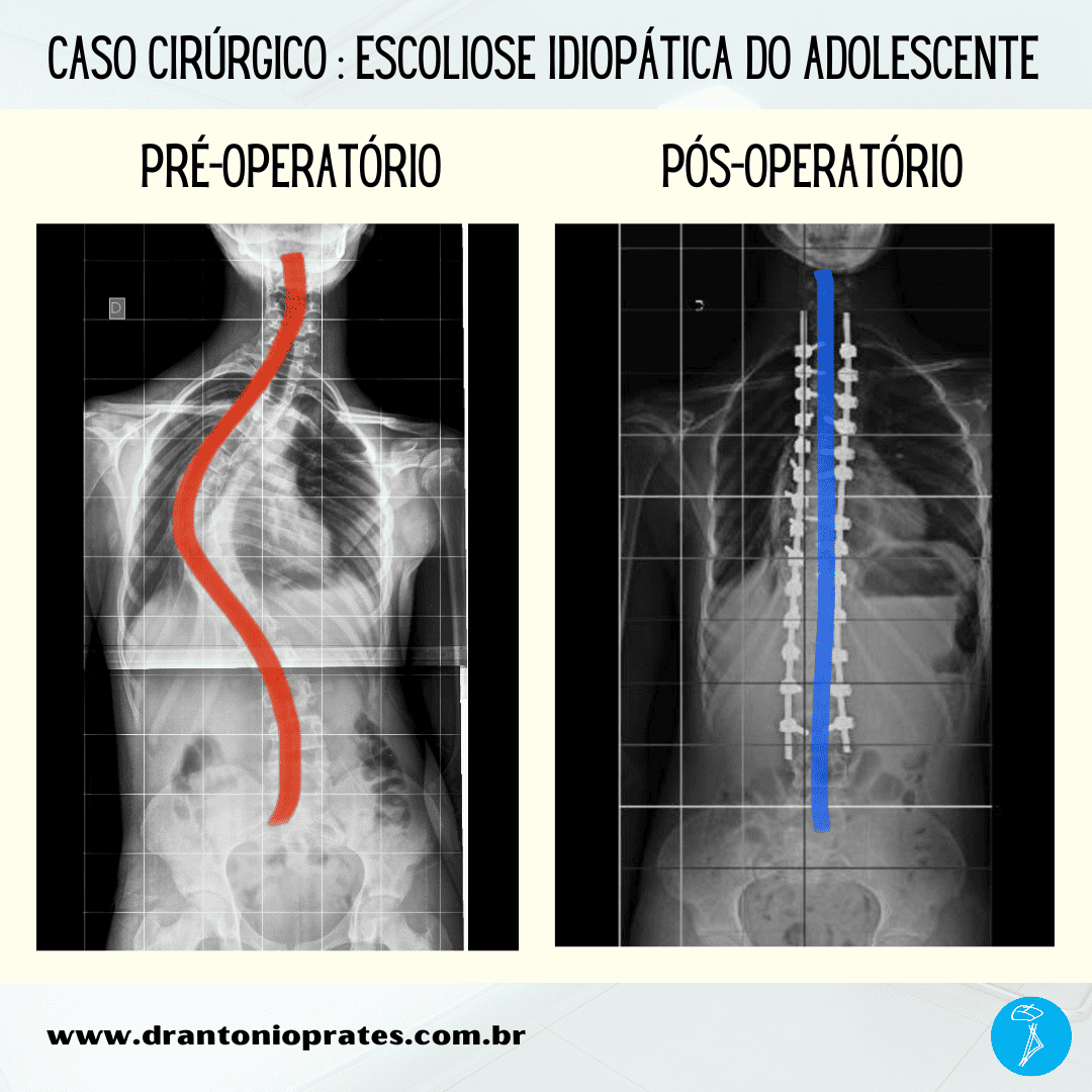 Escoliose idiopática do adolescente