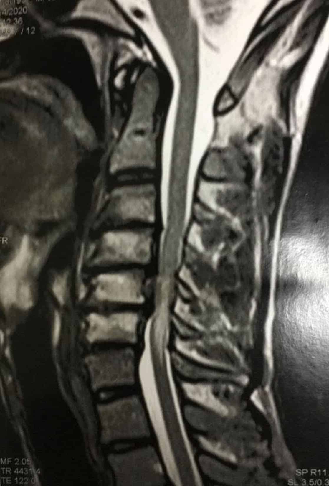 Cervicalgia e espondilose cervical