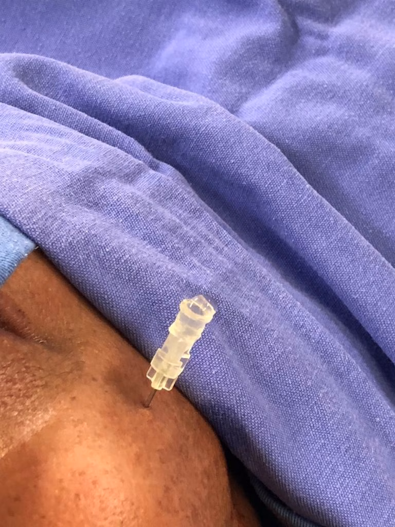 Plagiocefalia posicional