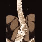 Artrodese de coluna lombar