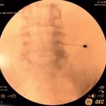 Tratamento intervencionista da dor crônica