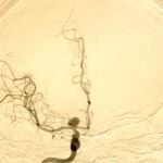 Procedimento neurocirúrgico - Dr Antônio Prates