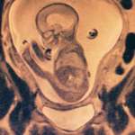 Tratamento de hidrocefalia em crianças