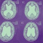Cirurgia de cranioestenose em bebês