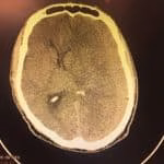 Hematoma subdural crônico - urgência neurocirúrgica