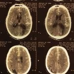 Hemorragia cerebral - urgência neurocirúrgica