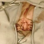 Tumor plexo lombar