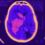 Urgência hematoma