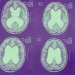 Neurocirurgia pediatrica