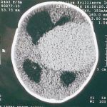 Neurocirurgia pediatrica