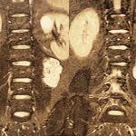 neurofibromatose