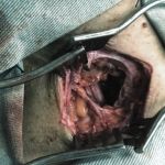 cirurgia plexo braquial