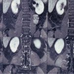 tumor plexo lombar