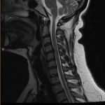 hernia de disco cervical