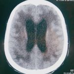 Neurocirurgia