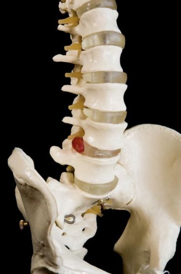 Metástase na coluna e compressão medular
