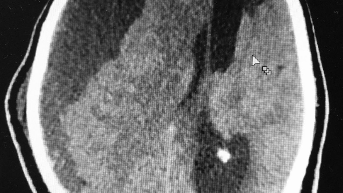 Hematoma subdural crônico
