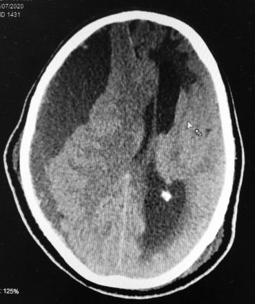 Hematoma subdural crônico