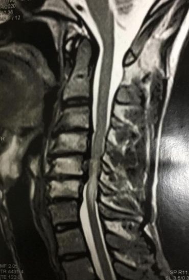 Cervicalgia e espondilose cervical