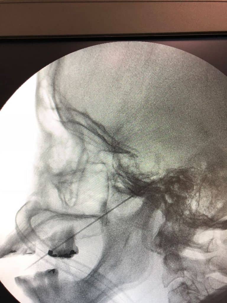 Neuralgia do trigêmeo