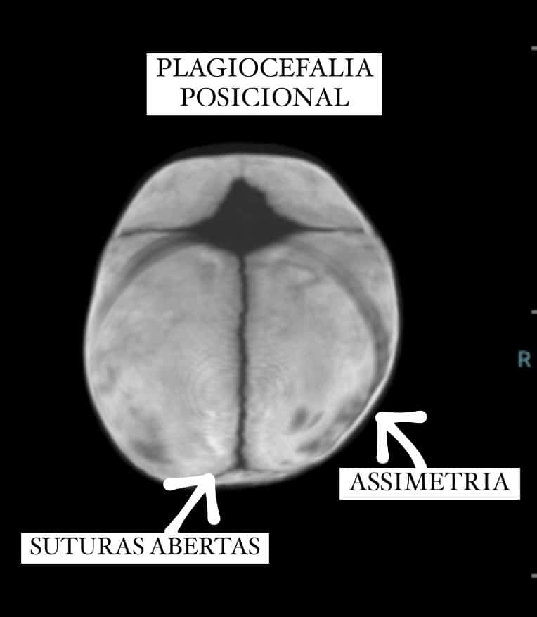 Plagiocefalia posicional