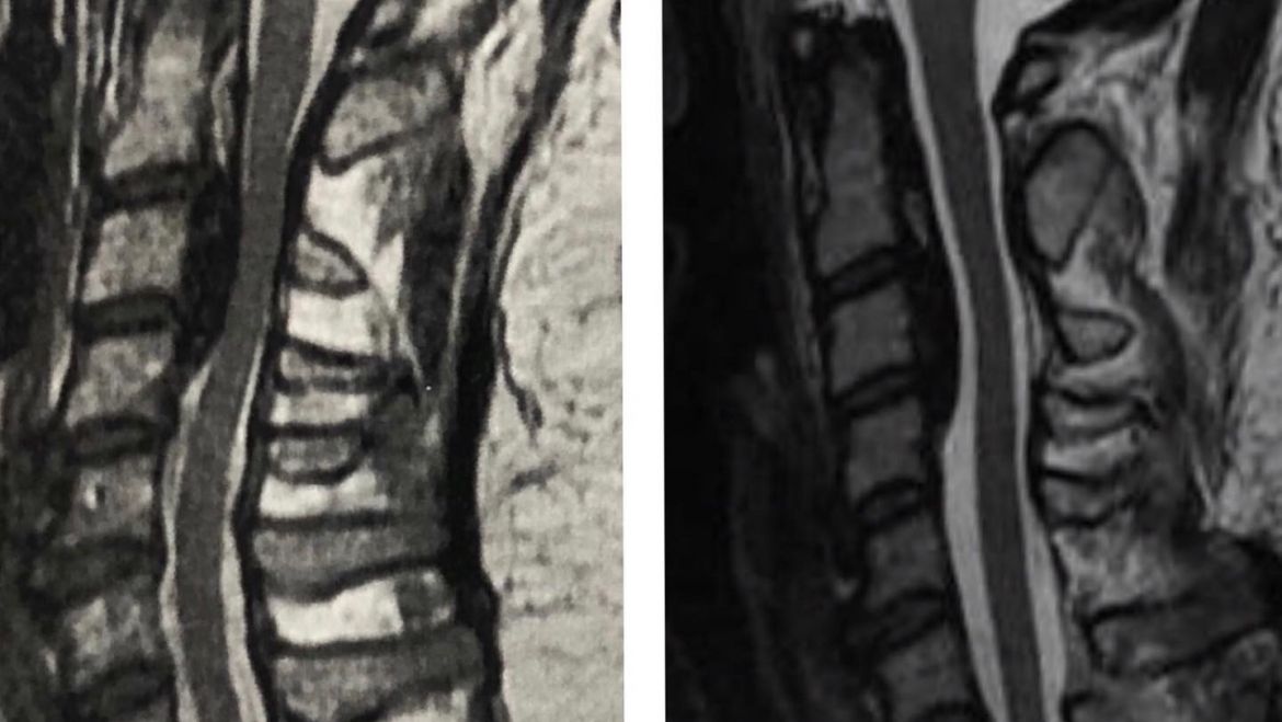 Dor cervical e Ossificação do ligamento longitudinal posterior