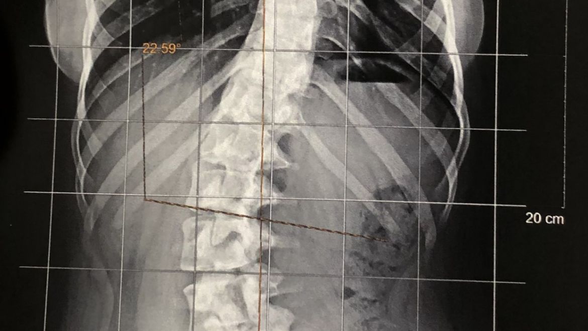 Escoliose idiopática adolescente