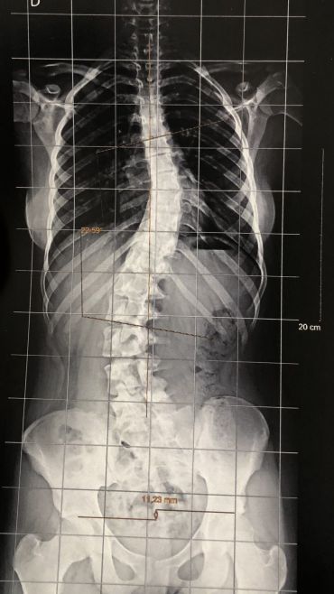 Escoliose idiopática adolescente