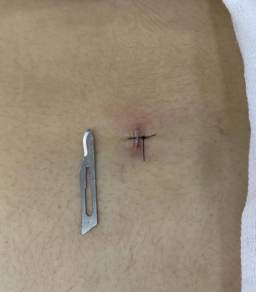 Pequena incisão na pela para endoscopia