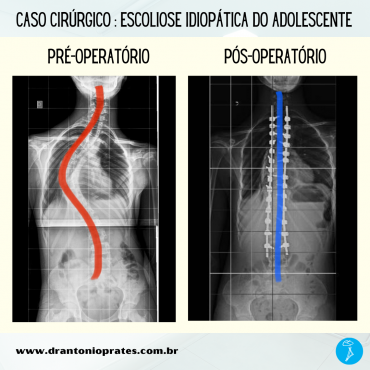 Escoliose idiopática do adolescente