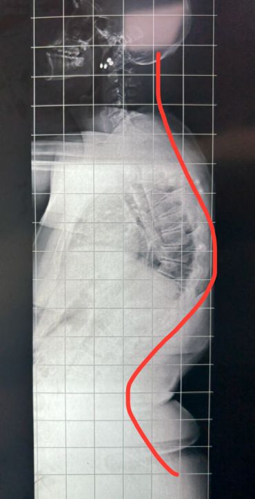 Cifose de Scheuermann: a famosa corcunda