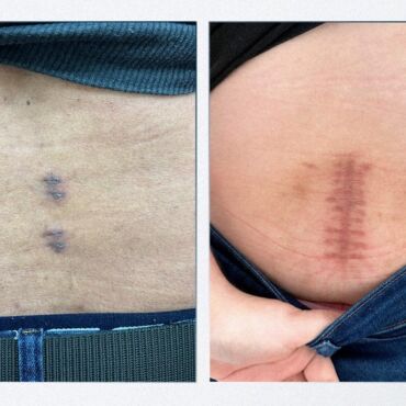 Endoscopia biportal da coluna: conheça a técnica