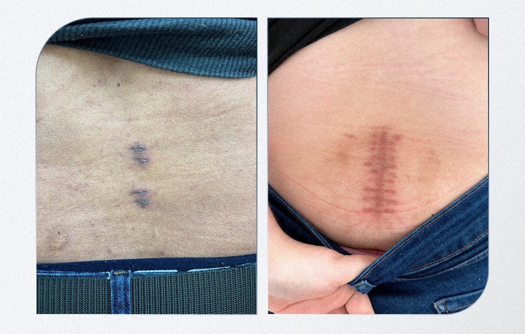 Endoscopia biportal da coluna: conheça a técnica